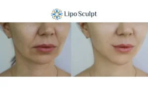 Explaining Total Skin Tightening Treatment And What It Can Do For You 2 Do you want to boost your self confidence? Give Morpheus8 Folkestone a try today!