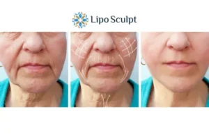 Explaining Total Skin Tightening Treatment And What It Can Do For You 3 Boost your confidence with Morpheus8 Folkestone call our team today!