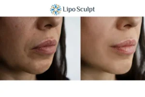 Explaining Total Skin Tightening Treatment And What It Can Do For You 4 Morpheus8 Folkestone the best results - call our team today!