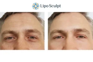 Explaining Total Skin Tightening Treatment And What It Can Do For You 6 Morpheus8 Folkestone book in today to find out more!