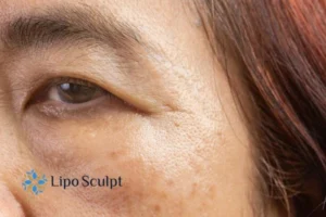 Cryopen: The Revolutionary Treatment for Age Spots Unveiled 2 Are age spots Folkestone giving you low self esteem? Contact us today!