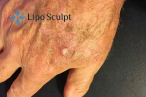 Best Actinic Keratoses Removal 2 Improve your wellbeing and health with Actinic Keratoses Folkestone removal.treatment