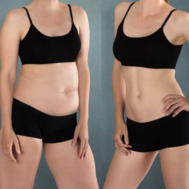 Does Fat Freezing at Home Work? DIY Devices vs Professional Cryolipolysis 2 before and after Cryolipolysis Folkestone