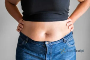 Bidding Farewell to Muffin Tops with Aqualyx Fat Injections 2 Do you wish you could reduce your muffin top Folkestone With Aqualy fat dissolving injections you can!