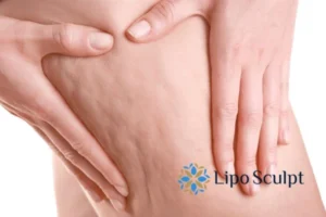 CoolSculpting for Legs: The Innovative Approach to Redefining Your Legs 5 Start your journey today book your coolsculpting treatment Folkestone online today!