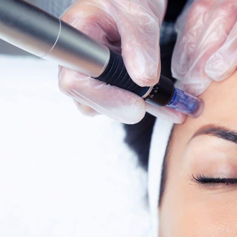 Morpheus8 treatment Folkestone from Lipo Sculpt - Book in today!