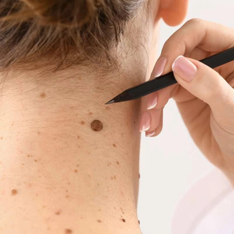 How to Support Your Body During Pregnancy for Faster Postnatal Recovery 5 See our lesion removal prices Folkestone - call today for a free quote