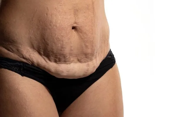 Lost the Weight but Not the Loose Skin? 1 image of womans stomach after weight loss showing loose skin Folkestone